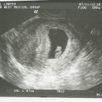 Seven-week ultrasound